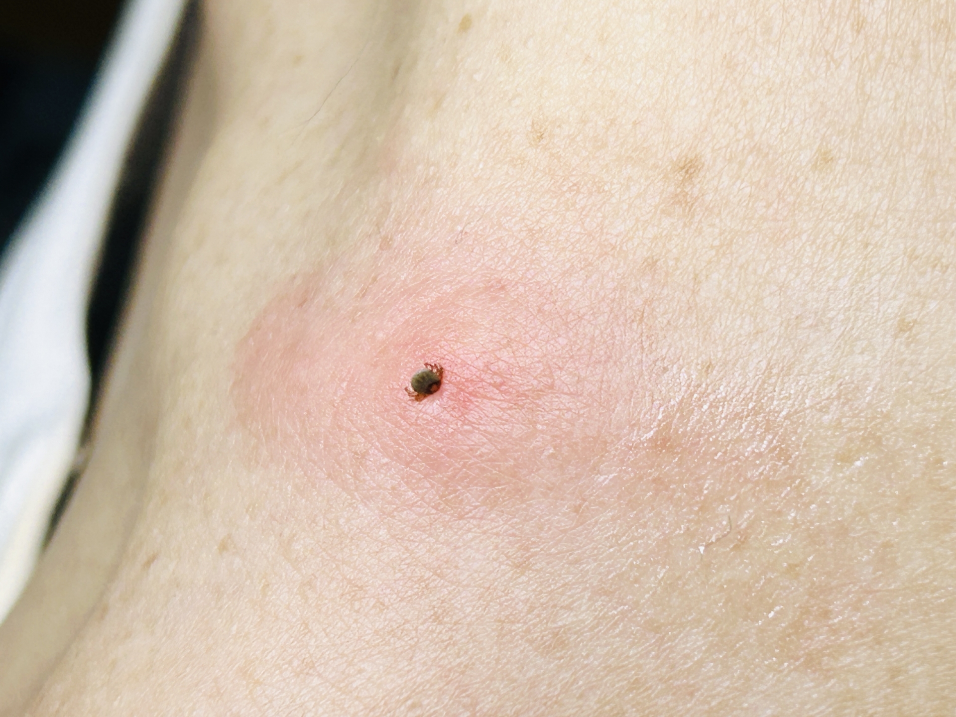 ダニが噛みついているイメージ